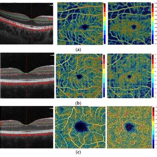 Octa Of The Macular Vessel Density B Scan Superficial Vascular