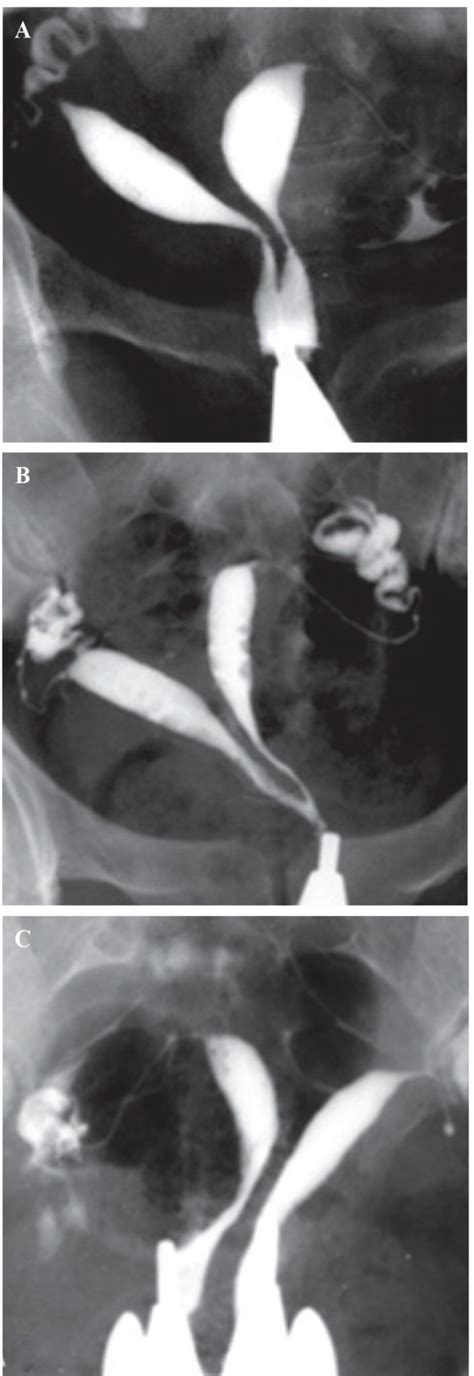 Hysterosalpingography In The Assessment Of Congenital Cervical