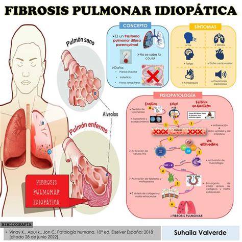 Fibrosis Pulmonar Idiopática Suhaila v m uDocz