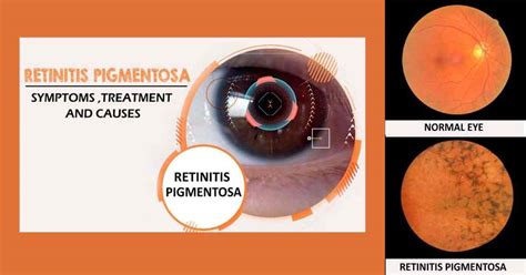 Retinitis Pigmentosa Treatment, Symptoms, And Causes - EyesOPT