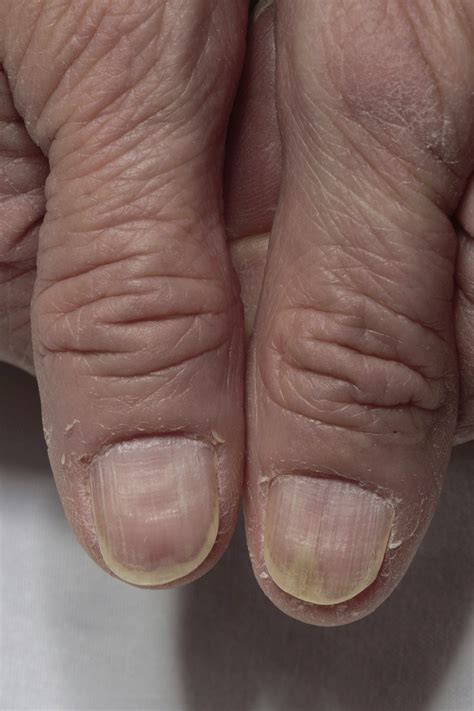 Nail Lichen Planus Mayo Clinic Proceedings