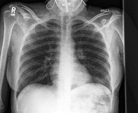 Ai System More Accurately Identifies Collapsed Lungs Using Chest X Rays