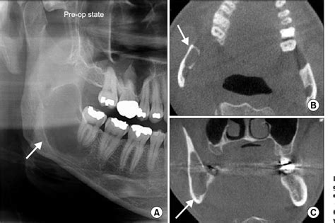 Figure 1 From Pseudoaneurysm Of The Inferior Alveolar Artery After