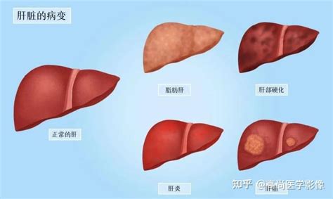 脂肪肝可以逆转吗？及时就诊干预很重要 知乎