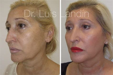 Lifting Facial con Cirugía Dr Landín Dr Thione