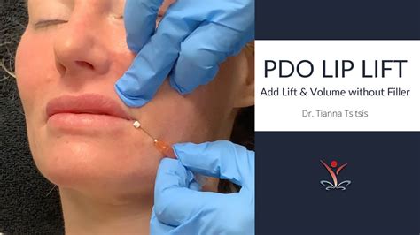 Pdo Thread Lip Lift Youtube