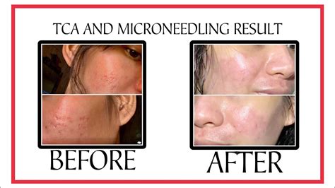 How To Treat Acne Scars Tca Cross Tca Peel Microneedling Result