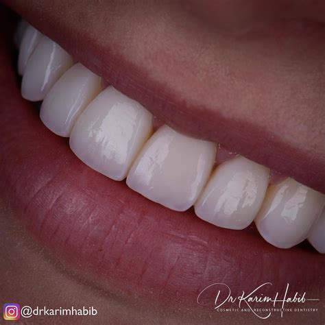 Composite Veneers Sydney Dental Bonding Sydney Dentist Ryde