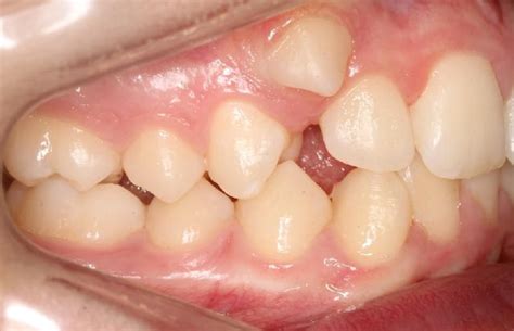 Dente Encavalado Quanto Tempo De Aparelho Conhe A Os Tipos De Aparelho