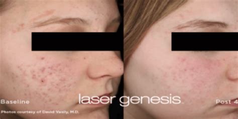 Did you know laser Genesis is great for Acne Scars! - Advanced Cosmetic ...