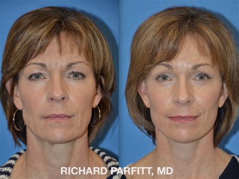 Forehead Lift Photos - Dr. Richard Parfitt