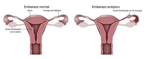 Instrumental De Laparoscopia Tecnicas Quirurgicas Para Embarazo Ectopico