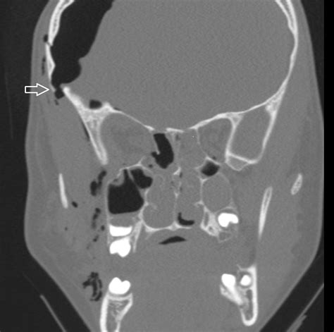 Acute Management Of Tension Pneumocephalus In A Pediatric Patient A