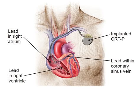 How Cardiac Resynchronization Devices Work Boston Scientific