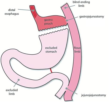 Roux En Y Gastric Bypass Anatomy