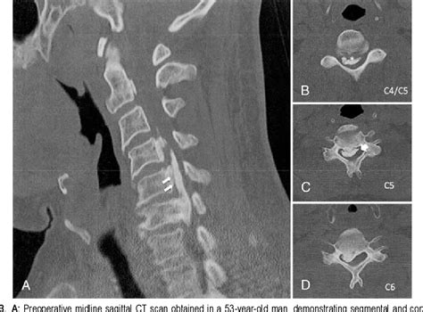 Figure 3 From Ossification Of The Posterior Longitudinal Ligament