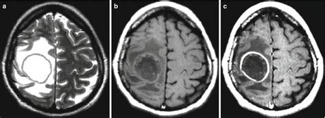 Intracranial Infection Radiology Key