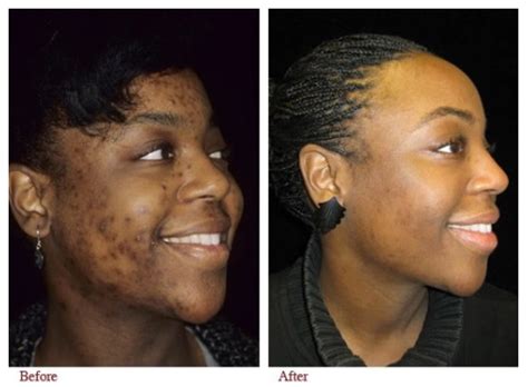 Hidroquinona Virilha Antes E Depois - Hidroquinona Antes E Depois