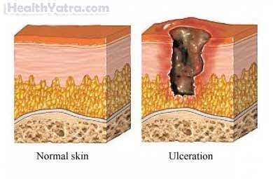 Pressure Sores Definition, Causes, Symptoms, Complications and Cost ...