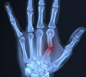 Hand Fractures Symptoms Causes Treatment By Wrist Thumb Braces