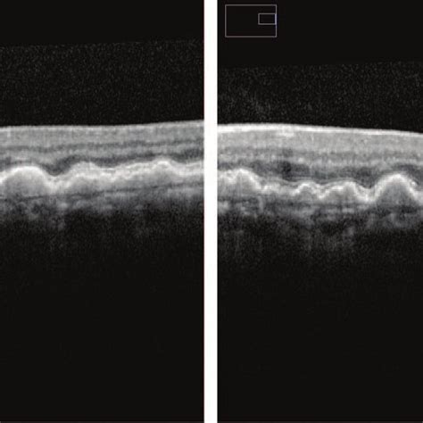 The left figure shows SD-OCT image of an eye with drusen. The drusen ...