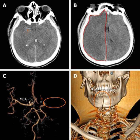 Imaging Of Case 2 A Computed Tomography Ct Showed A Hyperdense