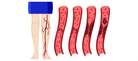 Popliteal Vein: Anatomy, Aneurysm, Thrombosis, and Embolism | Learn ...