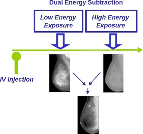 Contrast Enhanced Digital Mammography European Journal Of Radiology