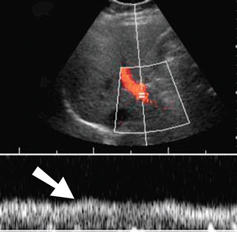 Postoperative Imaging In Liver Transplantation What Radiologists