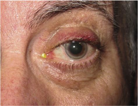 Eyelid And Ocular Surface Carcinoma Diagnosis And Management Clinics In Dermatology