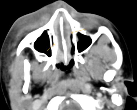 Nasal Septal Abscess Ct Sumers Radiology Blog