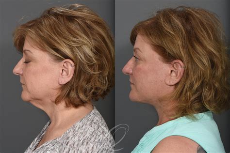 Facelift Before After Photos Patient 1491 Serving Rochester