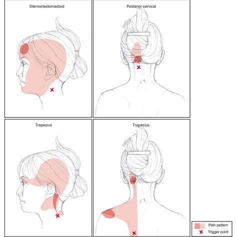 Posterior Trigger Points Neck