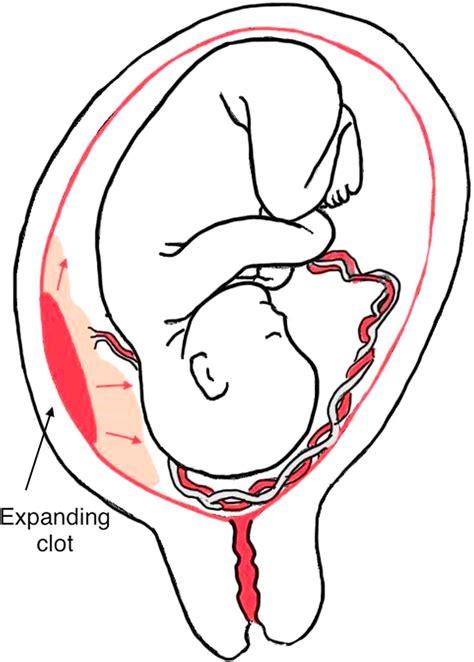 Antepartum Hemorrhage Clinical Tree