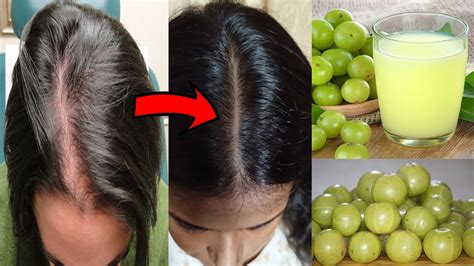 Amla For Hair Regrowth Different Ways To Use Amla Juice For Hair Care