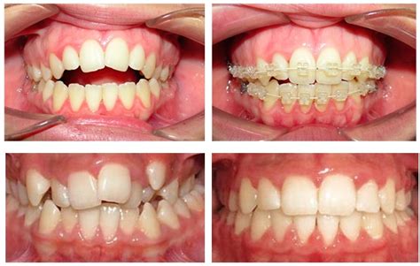 Ortodoncia De Forma Preventiva Interceptiva Y Correctiva Radio