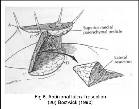 Figure 6 From Superomedial Pedicle Mammaplasty The Logical Extension