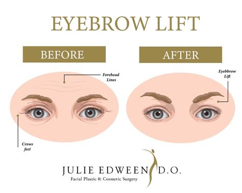 Eyebrow Lift Treats Crows Feet Forehead Lines And More Julie Edween