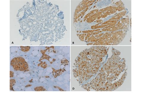 Representative Photographs Of Pd L1 Expression In Breast Cancer Tissue