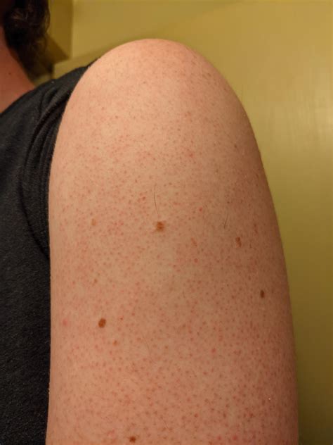 What Are All These Small Red Bumps On My Upper Arms This Is The Only