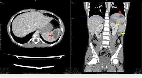 Axial And Coronal View Of Abdominal Ct Scan Showing Multiple Hypo Dense