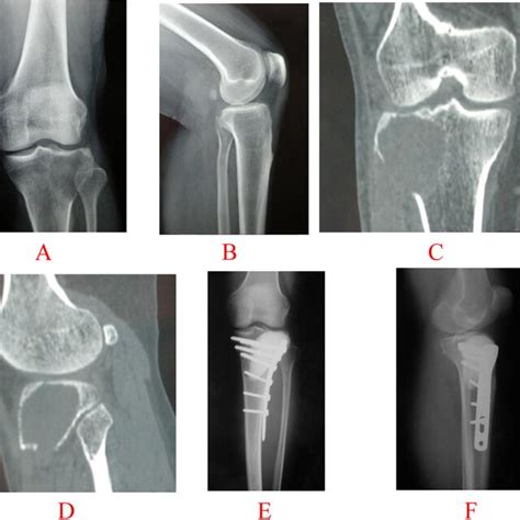 A 51 Year Old Male With A Simple Pathological Fracture Through Gct Of