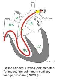pulmonary wedge pressure