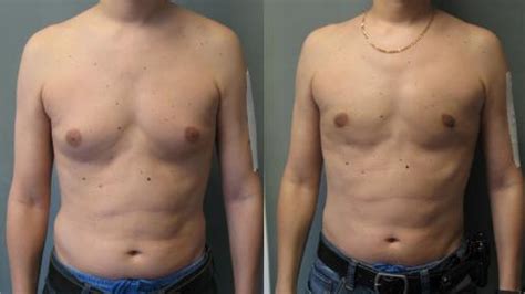 how to tell if you have gynecomastia - YouTube