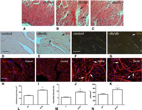 Diabetic Hearts Exhibit Atrial Cardiomyocyte Hypertrophy And Expansion