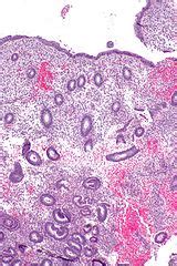 Proliferative Phase Endometrium Libre Pathology