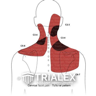 Cervical Facet Pain - Referred Pattern - TrialExhibits Inc.