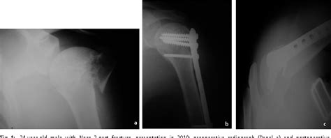 Figure 1 From Minimal Invasive Plate Osteosynthesis Mipo Technique