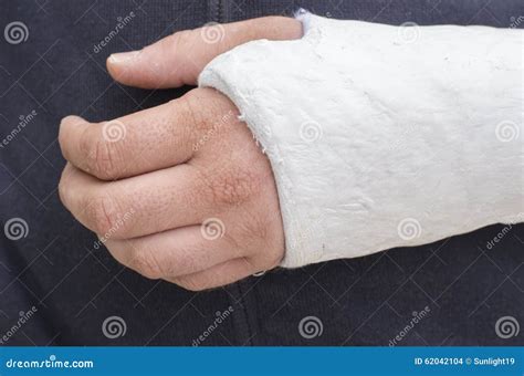 Man With His Broken Arm Arm In Cast Stock Photo Image Of Cast