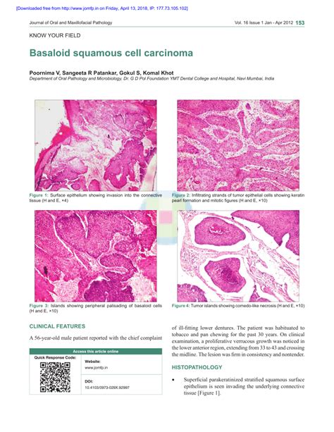 (PDF) Basaloid squamous cell carcinoma